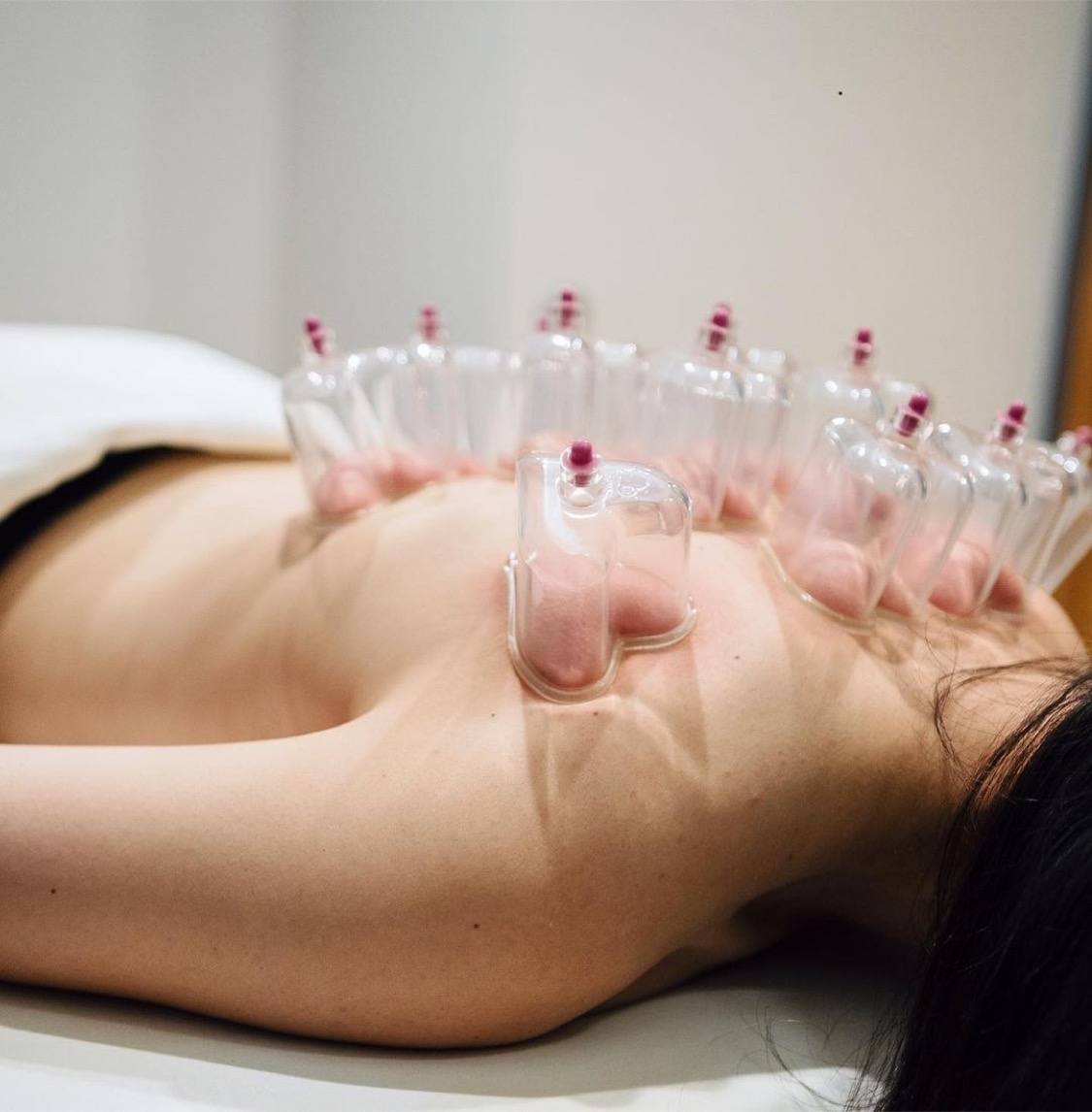 A cupping treatment from Serenity Spa & Natural Health Clinic